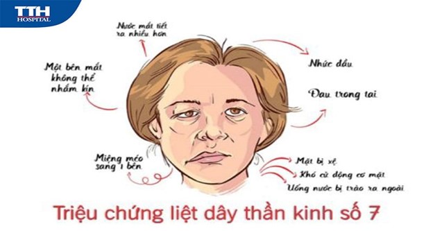 Liệt dây thần kinh số VII (liệt mặt ngoại biên): đừng chủ quan khi bị méo miệng, lệch mặt